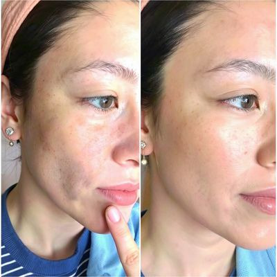 피부 미백 효과