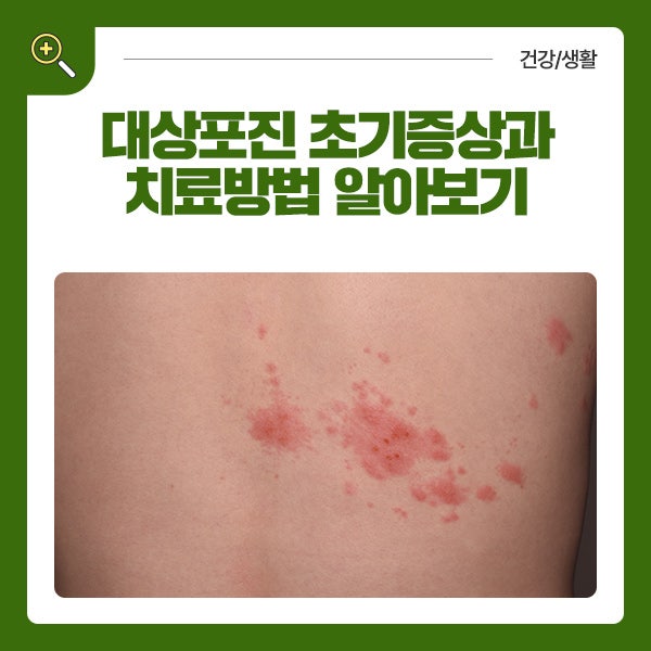 대상포진