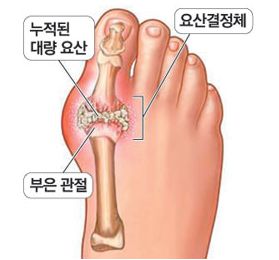 통풍초기증상