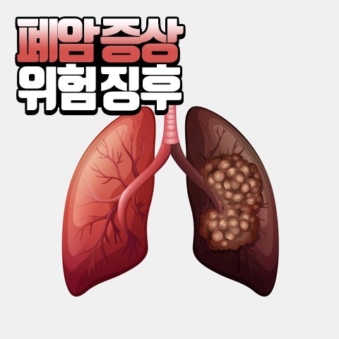 폐암예시