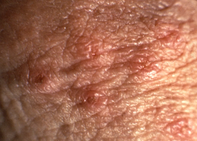 사타구니 가려움증