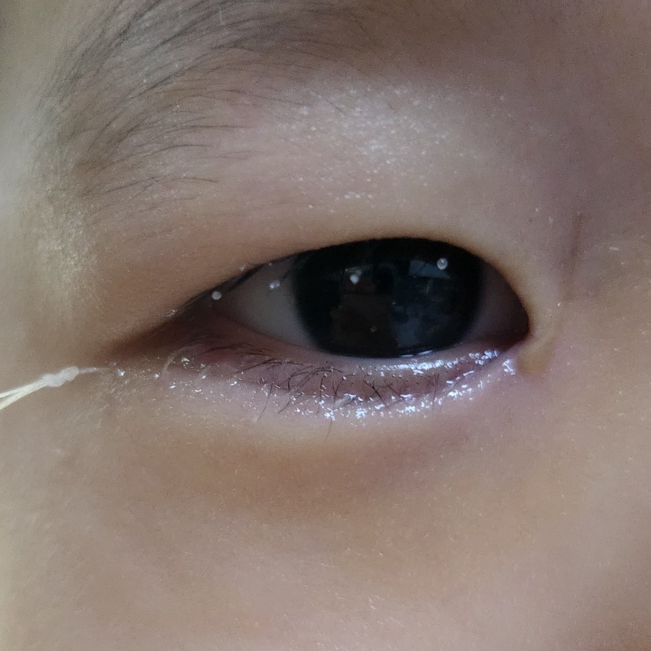 수술 4일 후 눈