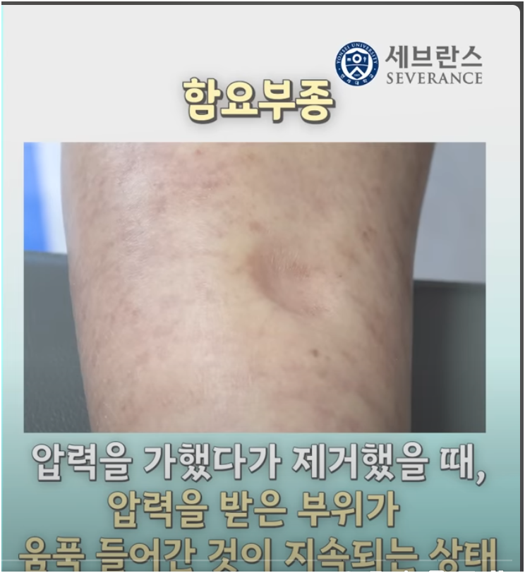 출처; 조선일보 의학건강, 세브란스와 함께하는 심장건강지키기, 심부전 증상 함요부종