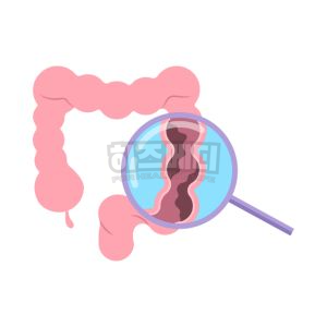 분변 잠혈검사 양성