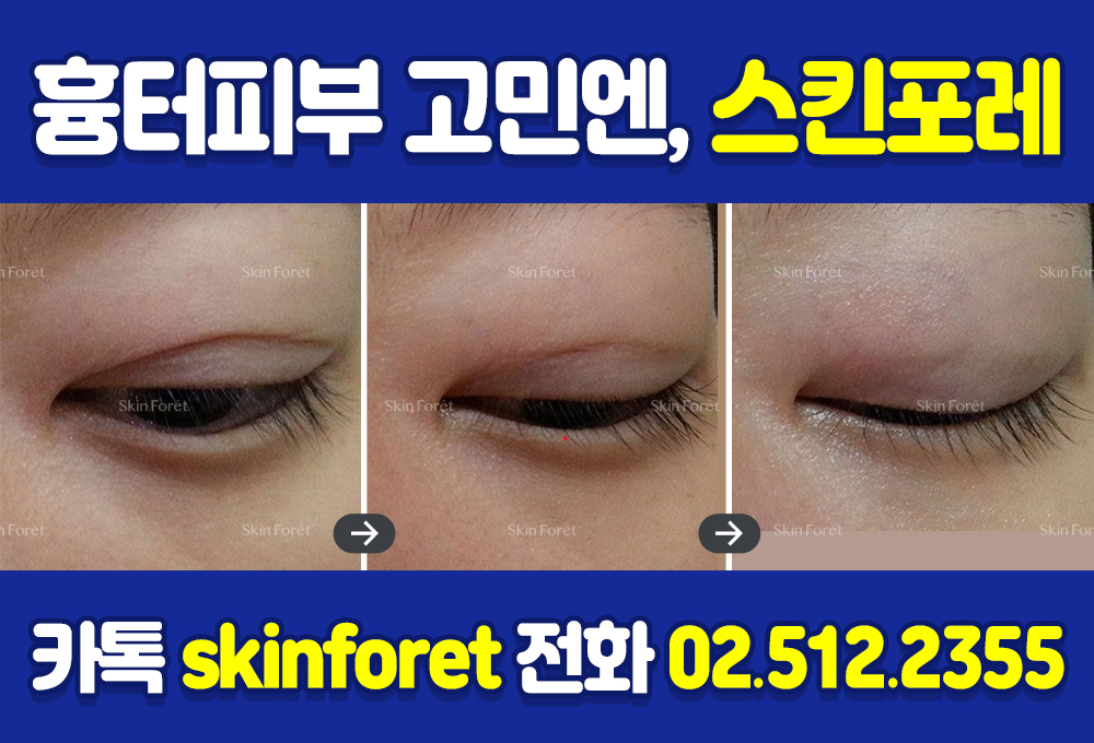 쌍꺼풀수술 후 오래된 흉살, 피부 뭉침 관리