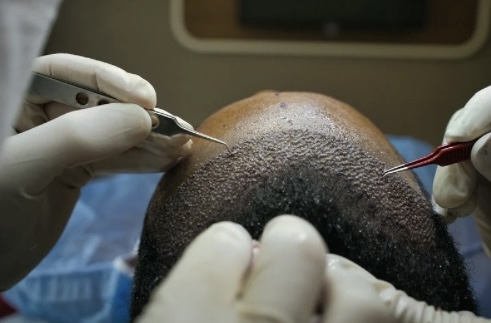 모발 이식: 방법, 절차, 그리고 기대 효과