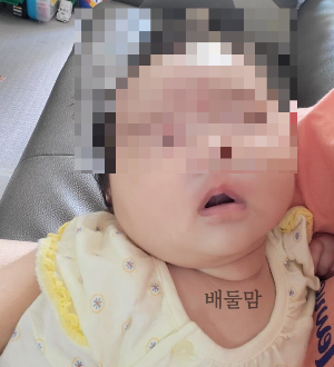 둥근 젖꼭지 사용으로 입 주변이 빨개진 아기.