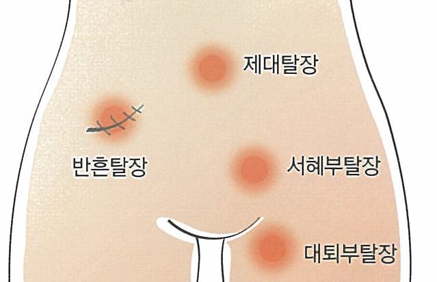 1. 탈장 수술 비용