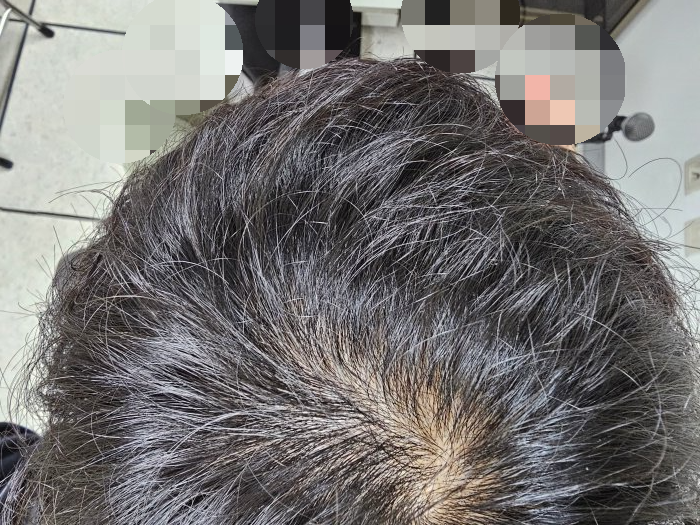탈모가-시작된-두피