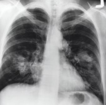 천식 치료법 진단 기준 합병증
