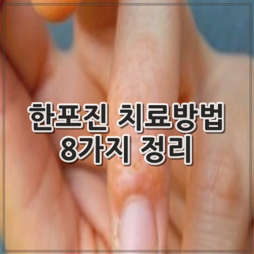 한포진 치료방법 8가지 정리