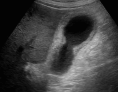 급성 담낭염 (Acute cholecystitis)