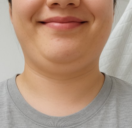 웃고-있는-여성의-이중턱-사진입니다.