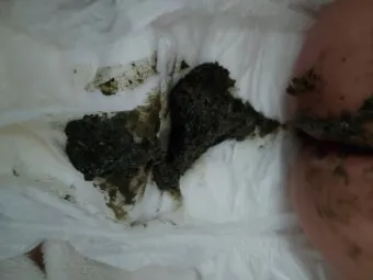 똥이 까만색 검정똥 원인과 질병 가능성_18