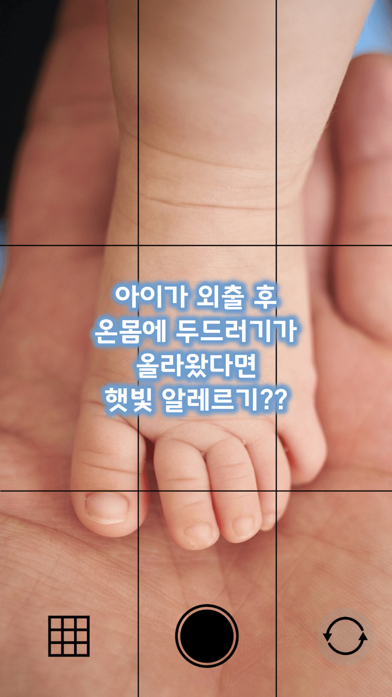 아이 외출 후 햇빛 알레르기 케어 방법