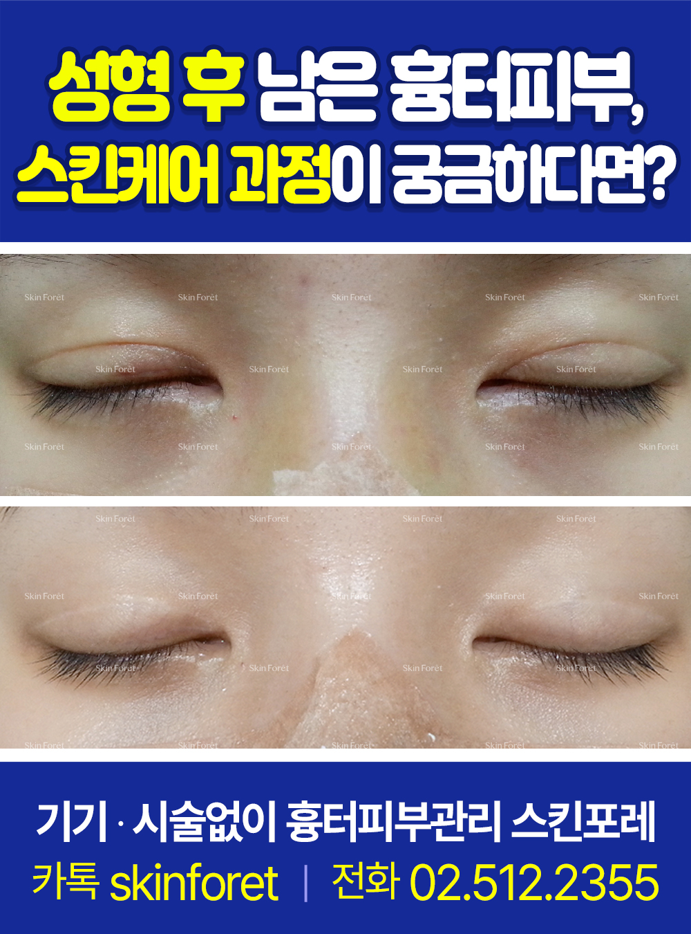 쌍꺼풀 절개법 진행 후 생긴 흉터 관리 전후 사진