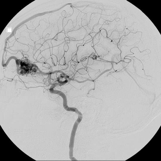 동정맥 기형(AVM) &ndash; 원인, 증상, 진단 및 치료법