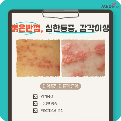 대상포진: 이해와 예방