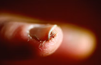 피부질환 종류 연고 종류 이유