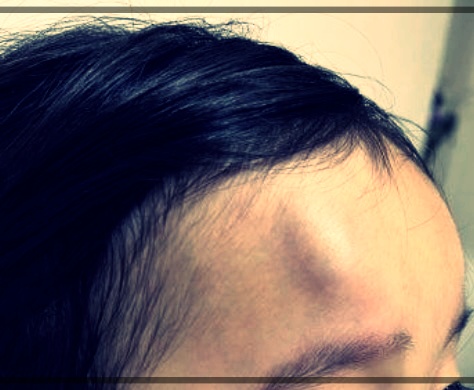 냉찜질로 빠르게 가라앉힌 머리 혹, 직접 해본 효과적인 방법