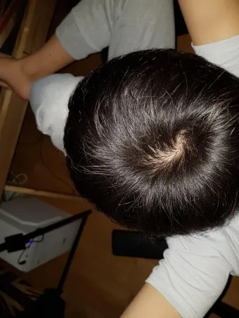 정수리가 아픈 이유와 완화하는 방법_14