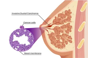 유방암-2기-생존율