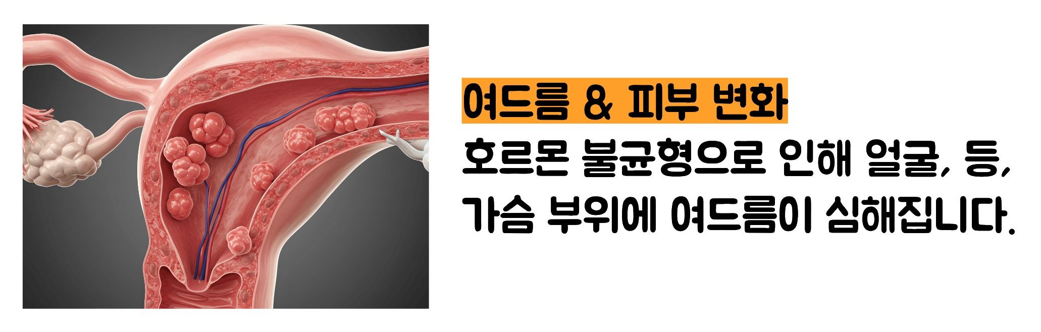 다낭성 난소 증후군 증상