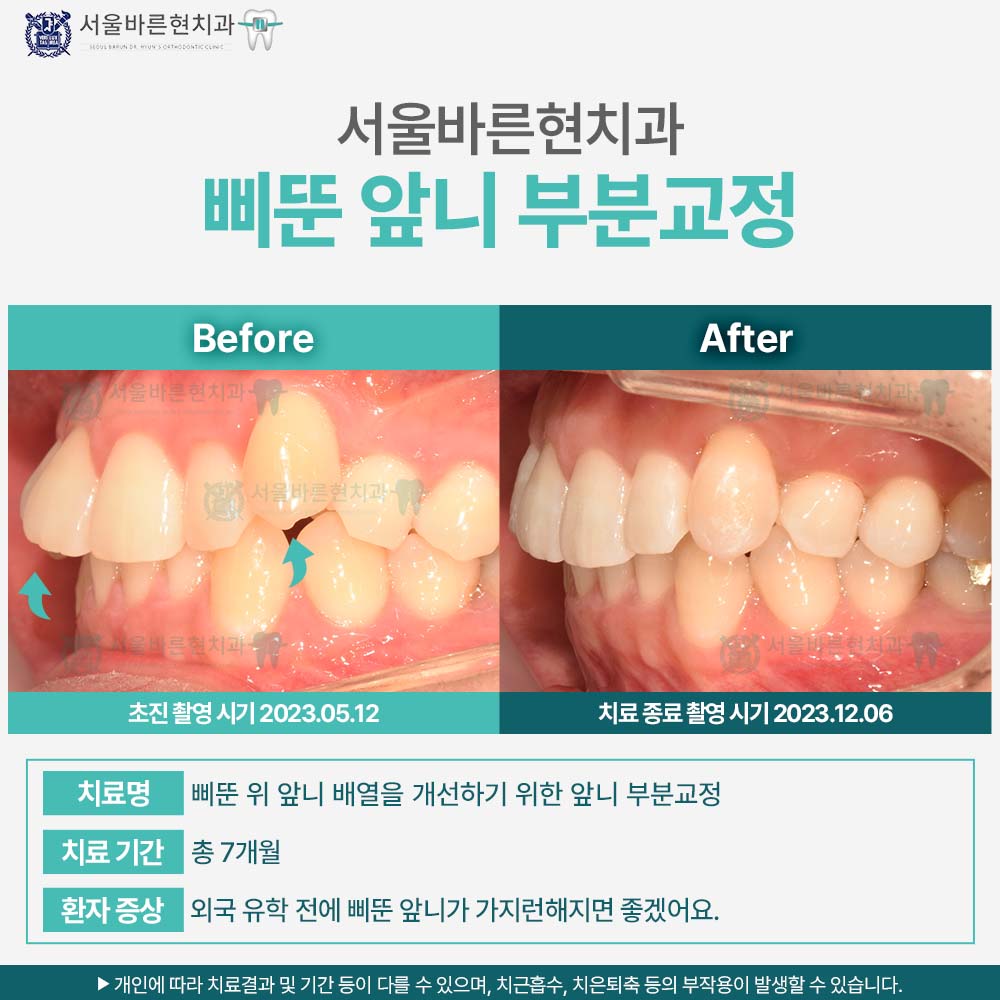 마린시티앞니교정
