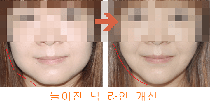 전과 후 차이점