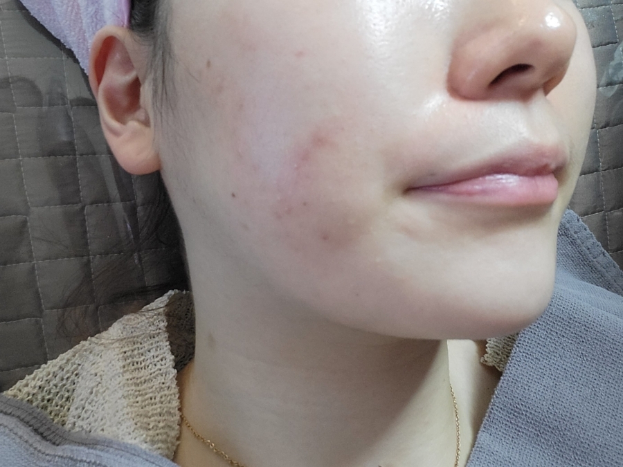 bbl 레이저 후기