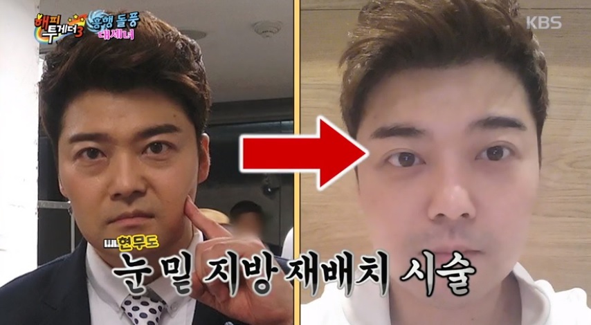 전현무 눈밑지방재배치 수술