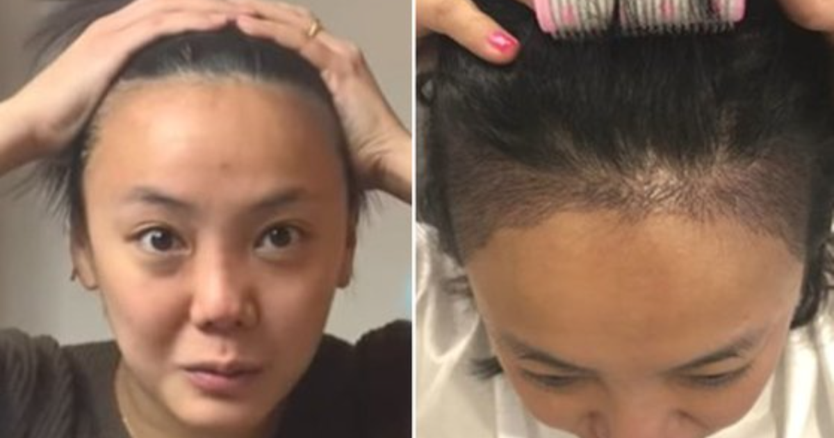 탈모치료 탈모약 모발이식 탈모샴푸 흑채스프레이