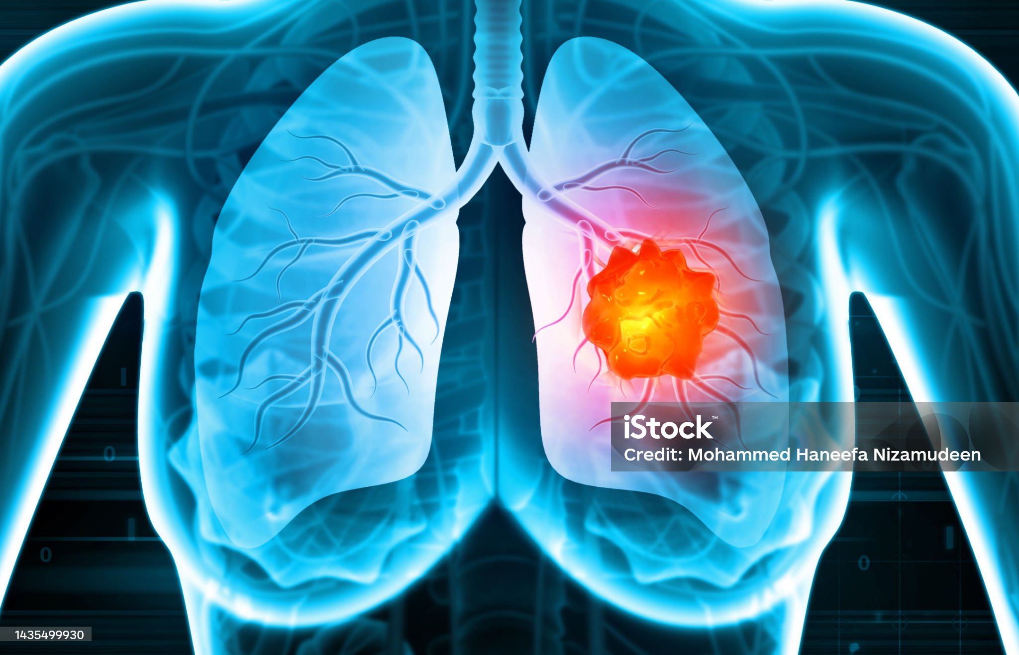 폐암-관련-사진