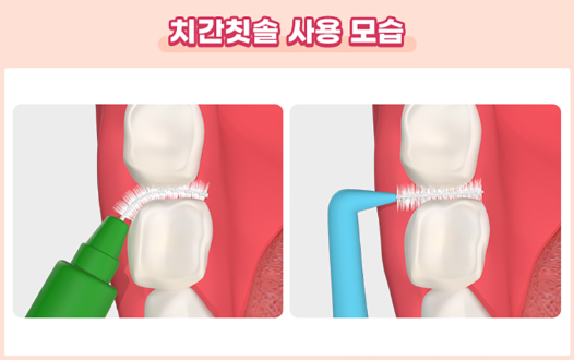 입냄새 원인, 입냄새 제거, 입냄새 확인 및 입냄새 관리 치료방법 안내