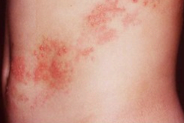 50세 이상 대상포진 이미지사진