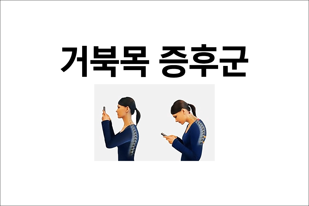 거북목 증후군 원인 증상 예방 치료