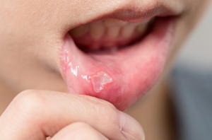 입안을 씹을 경우