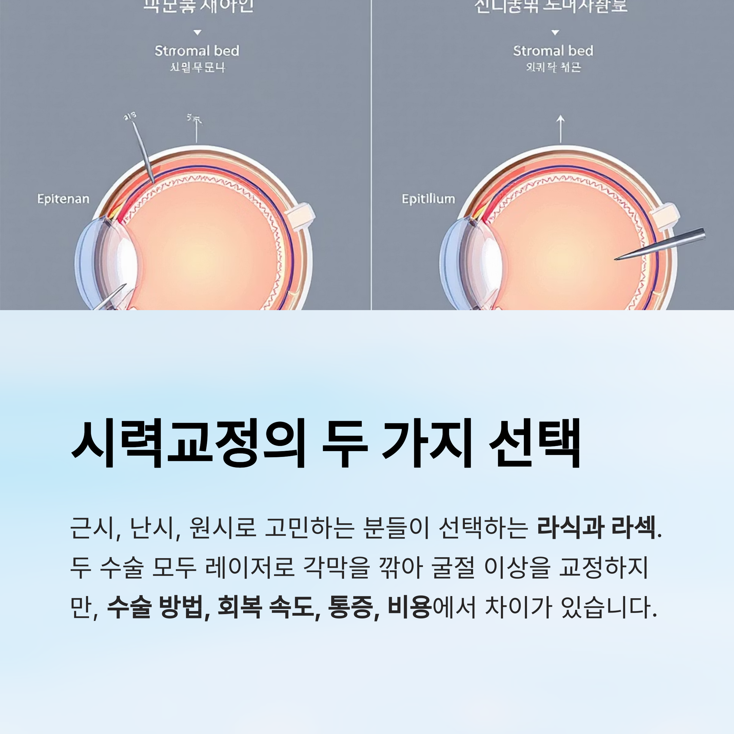 라섹과 라식의 차이점과 수술 비용 비교 완전 가이드