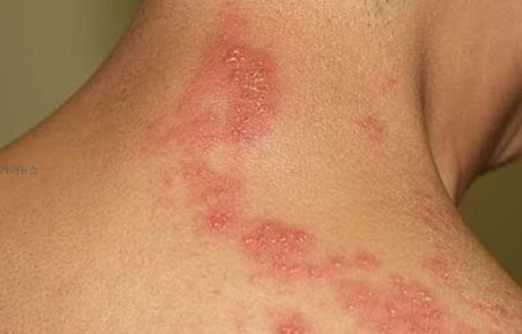 대상포진예방접종&amp;#44; 백신종류 비용