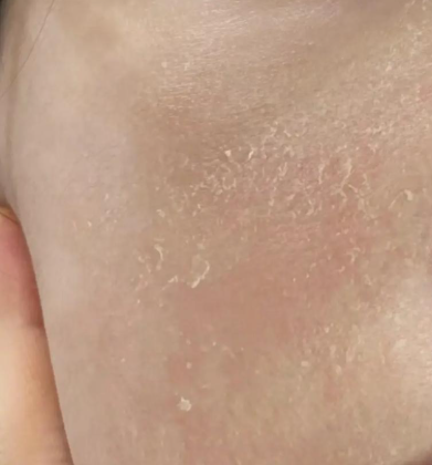 비판텐 가격은? 문제성 피부 조직 회복과 보습 효과를 가진 연고라 상비약으로 두기 딱 좋은 듯