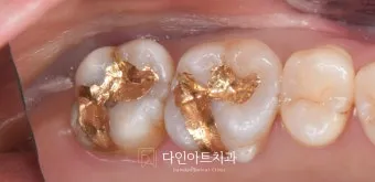 인레이 온레이의 차이와 치료 방법_13