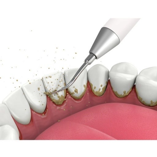 스케일링으로 치석을 제거하는 그림