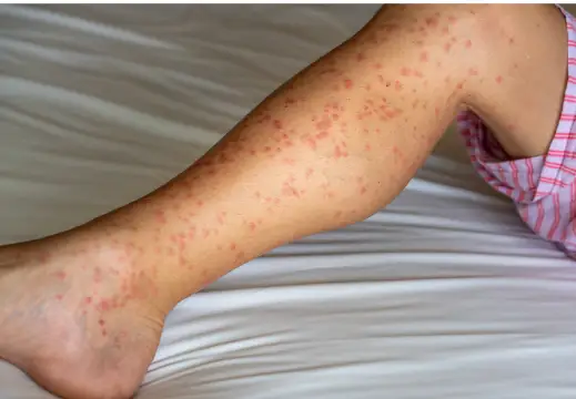 두드러기 원인 및 치료방법