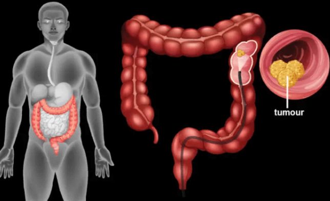 대장암 초기증상