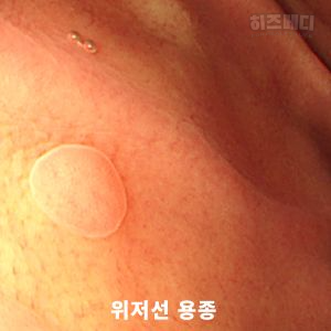 위저선 용종