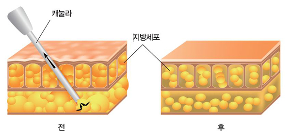 다이어트 방법: 수술 다이어트