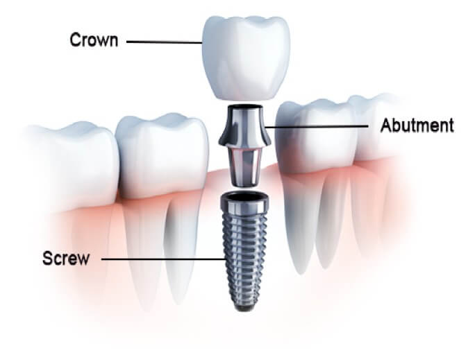 임플란트 보험 임플란트 가격 임플란트 비용 치아 보험 추천 치과 보험 추천 임플란트 치아 보험 치아 보험 적용 기과 보험 적용 치과 보험 임플란트 임플란트 치아