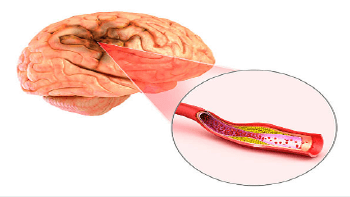 허혈성 뇌졸중 원인