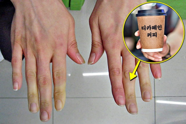 추울때 손가락 끝이 하얗게 레이노 증후군 증상 예방법 무카페인 커피