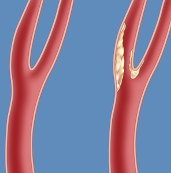 경동맥 초음파 검사란? mra 플라크 수치